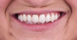 Read more about the article O que são implantes dentários? É um procedimento dolorido?