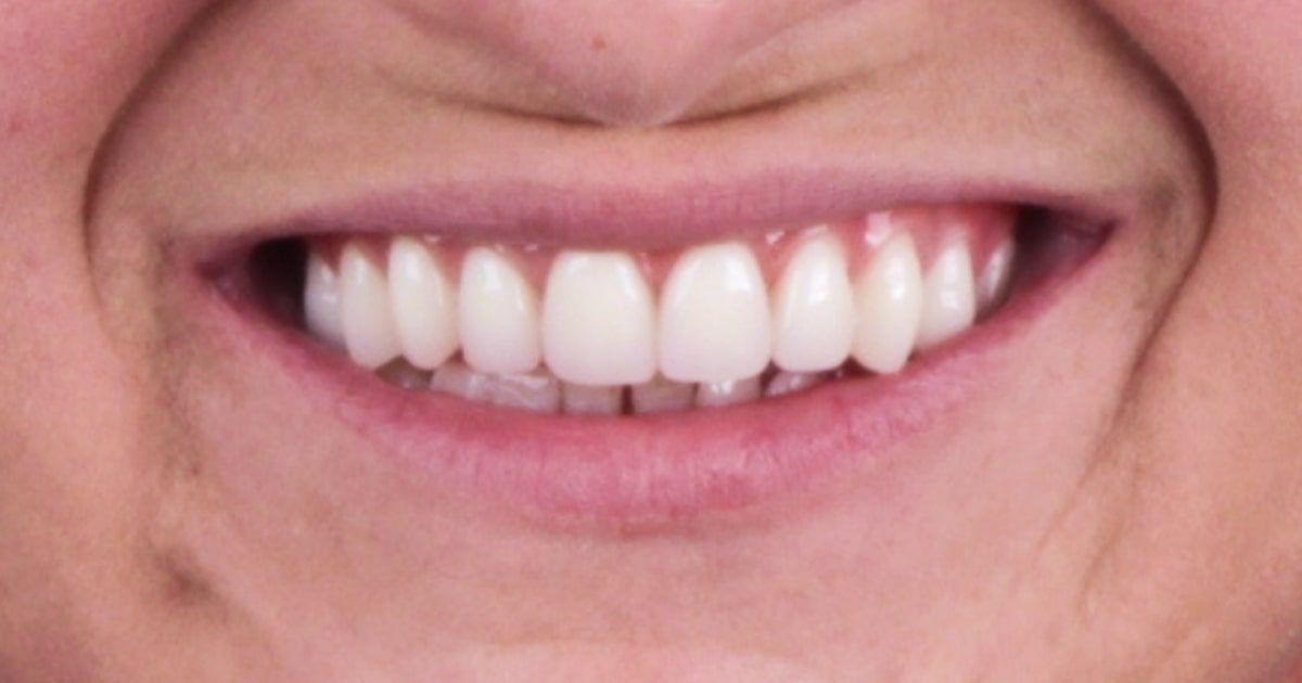 You are currently viewing O que são implantes dentários? É um procedimento dolorido?