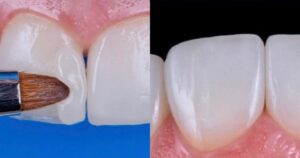 Read more about the article Quais são as diferenças entre facetas de resinas e lentes de porcelana?