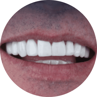 Facetas em resna-min Dentista em Balneário Camboriú - Rise - Clínica Odontológica