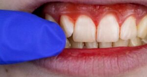 Read more about the article Minha gengiva sangra, é normal?