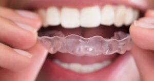 Read more about the article Quais são os tipos de clareamento?