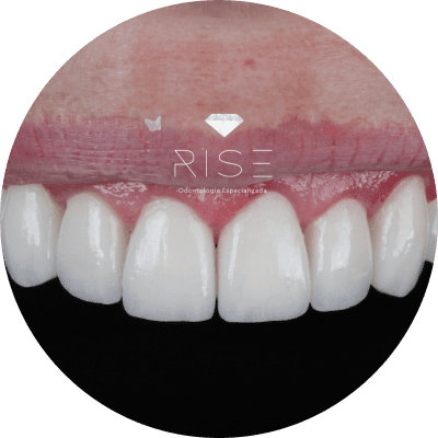 lentes de contato-min Dentista em Balneário Camboriú - Rise - Clínica Odontológica