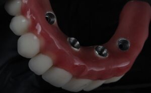 Read more about the article O que é implante com carga imediata, e quem pode fazer?