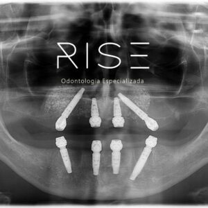 Read more about the article O que são os implantes dentários ALL-ON-FOUR, mais conhecido como “protocolo sobre implantes ALL-ON-FOUR”? Precisa de enxerto ósseo