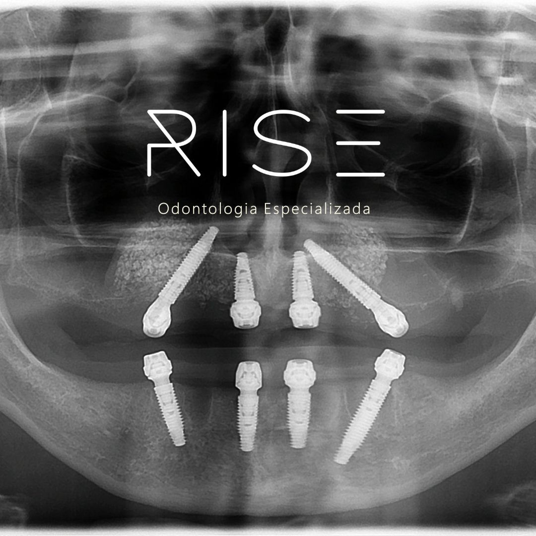 You are currently viewing O que são os implantes dentários ALL-ON-FOUR, mais conhecido como “protocolo sobre implantes ALL-ON-FOUR”? Precisa de enxerto ósseo