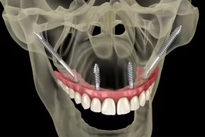 Read more about the article Como evitar enxerto ósseo em tratamento com implantes? Entenda mais sobre os implantes zigomáticos.